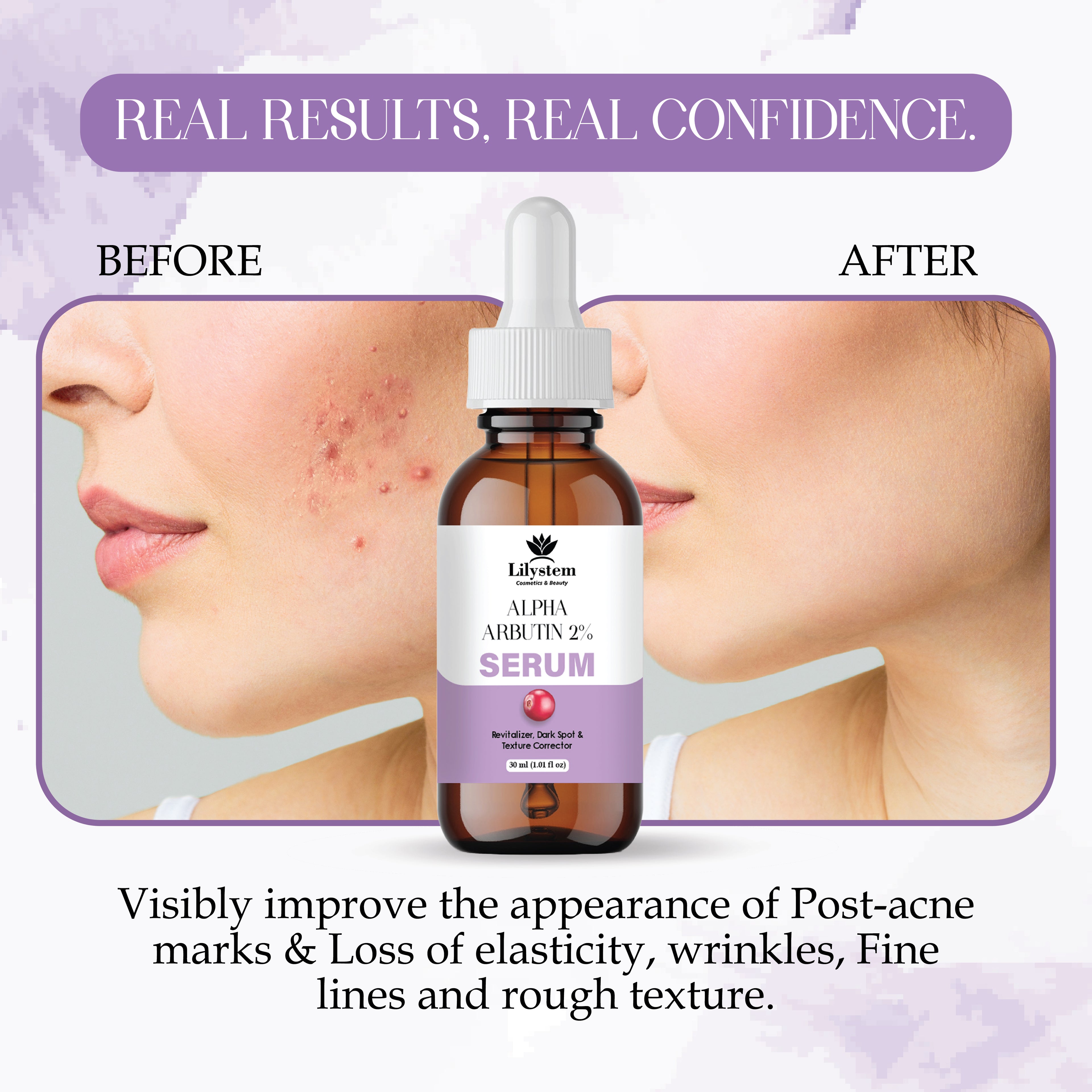 Alpha Arbutin Serum for Dark Spots, Hyperpigmentation & Uneven Skin Tone – Brightening Face Serum with Hyaluronic Acid & Niacinamide